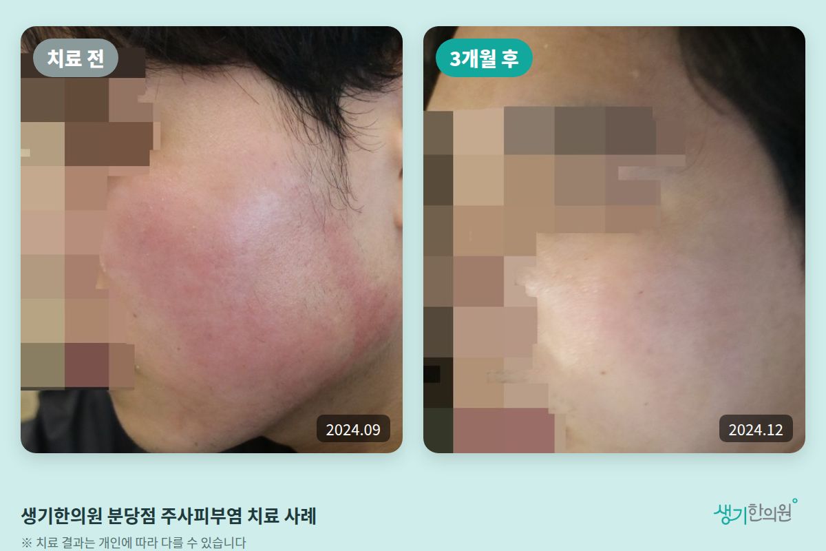 생기한의원 분당점 주사피부염 치료 전(2024.09)과 3개월 후(2024.12) 비교 사진