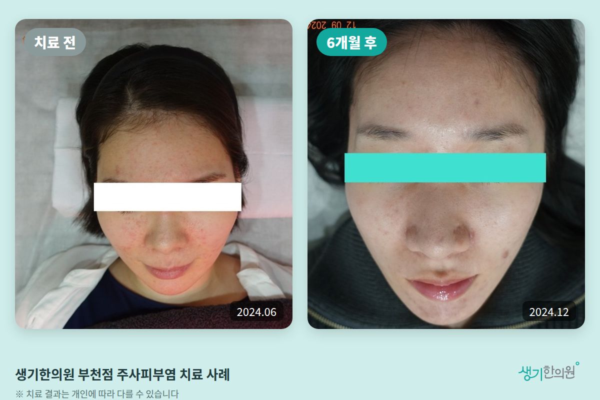 생기한의원 부천점 주사피부염 치료 전(2024.06)과 6개월 후(2024.12) 비교 사진