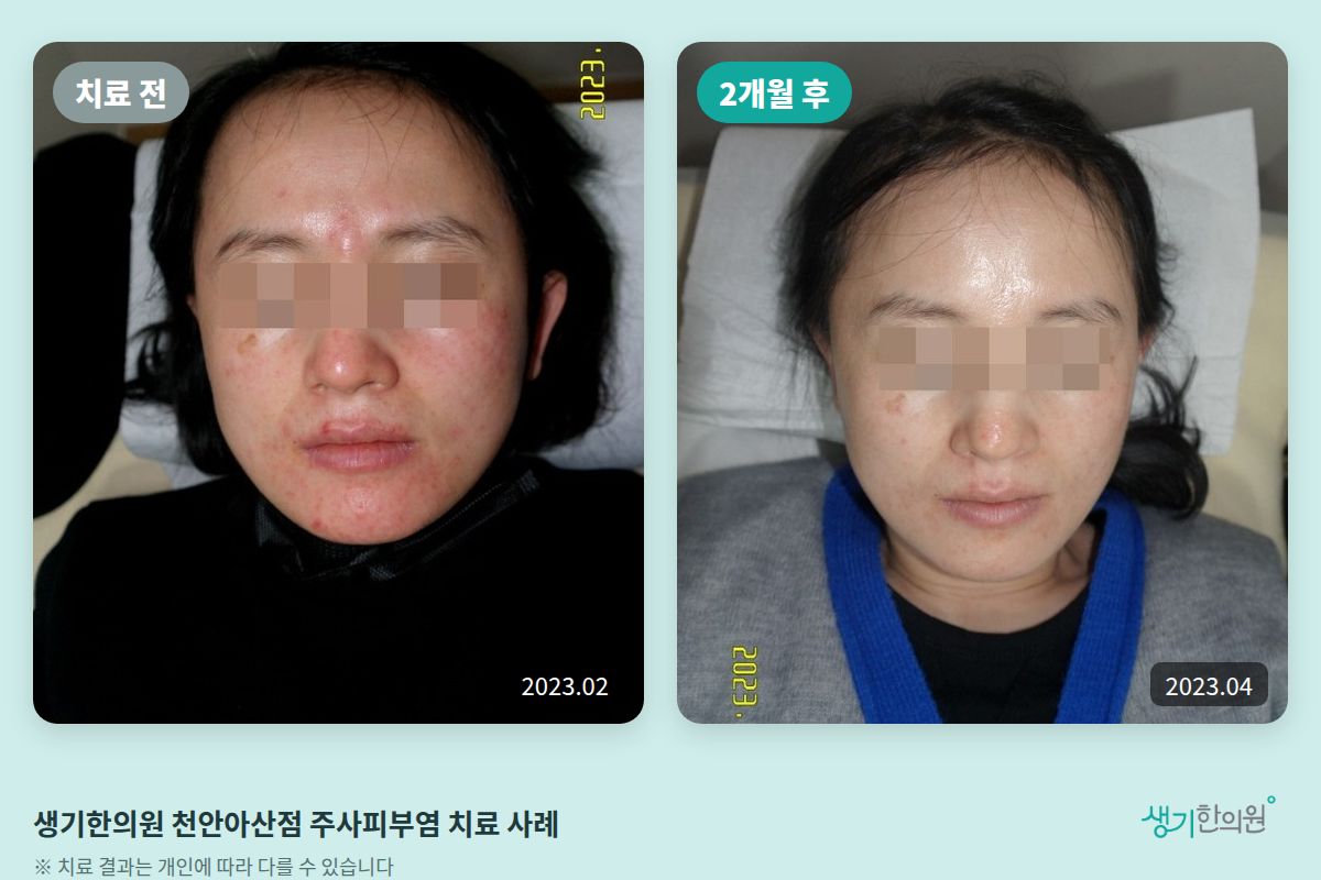 생기한의원 천안아산점 주사피부염 치료 전(2023.02)과 2개월 후(2023.04) 비교 사진