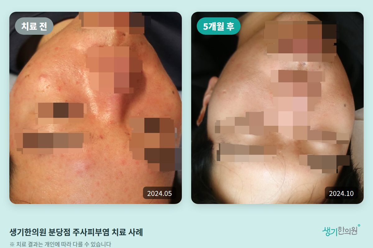 생기한의원 분당점 주사피부염 치료 전(2024.05)과 5개월 후(2024.10) 비교 사진