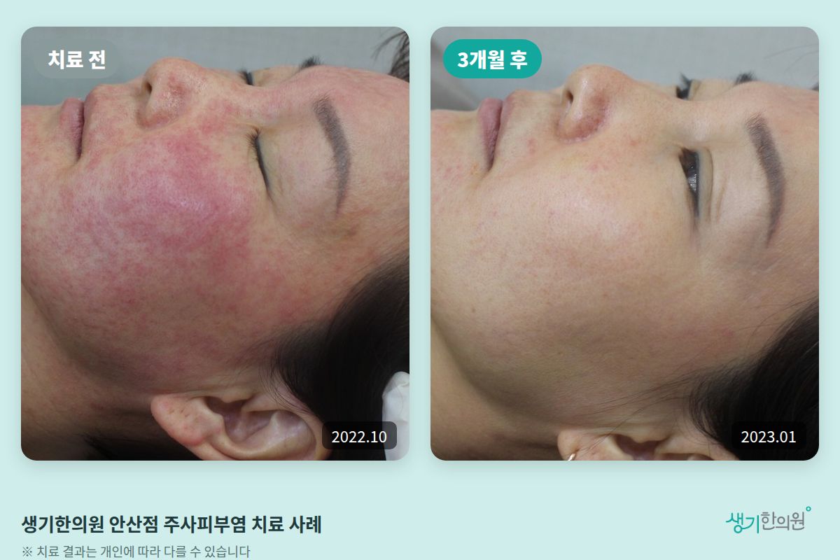 생기한의원 안산점 주사피부염 치료 전(2022.10)과 3개월 후(2023.01) 비교 사진