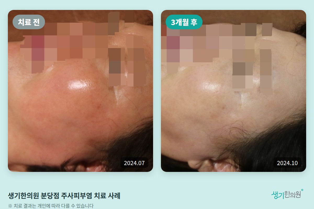생기한의원 분당점 주사피부염 치료 전(2024.07)과 3개월 후(2024.10) 비교 사진