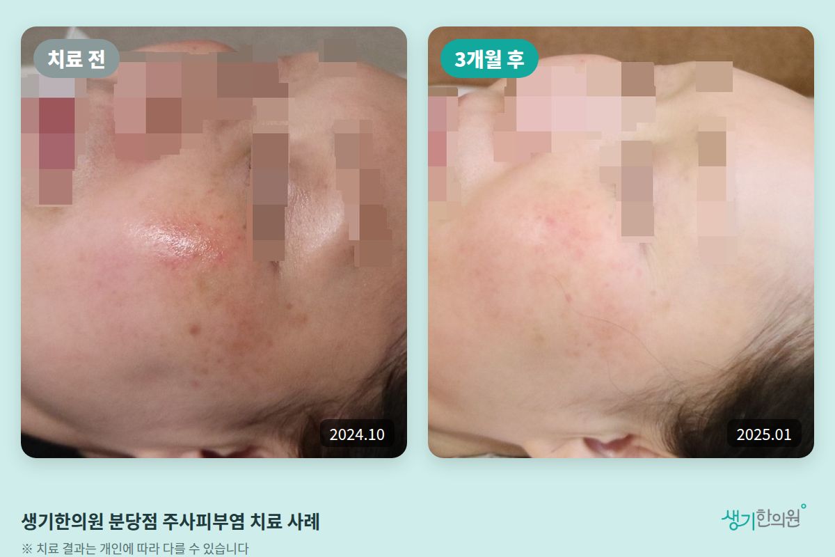 생기한의원 분당점 주사피부염 치료 전(2024.10)과 3개월 후(2025.01) 볼 비교 사진