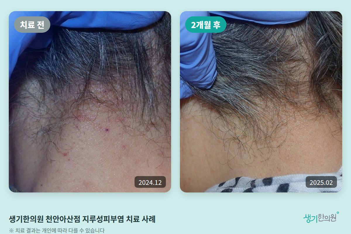 생기한의원 천안아산점 지루성피부염 치료 전(2024.12)과 2개월 후(2025.02) 비교 사진