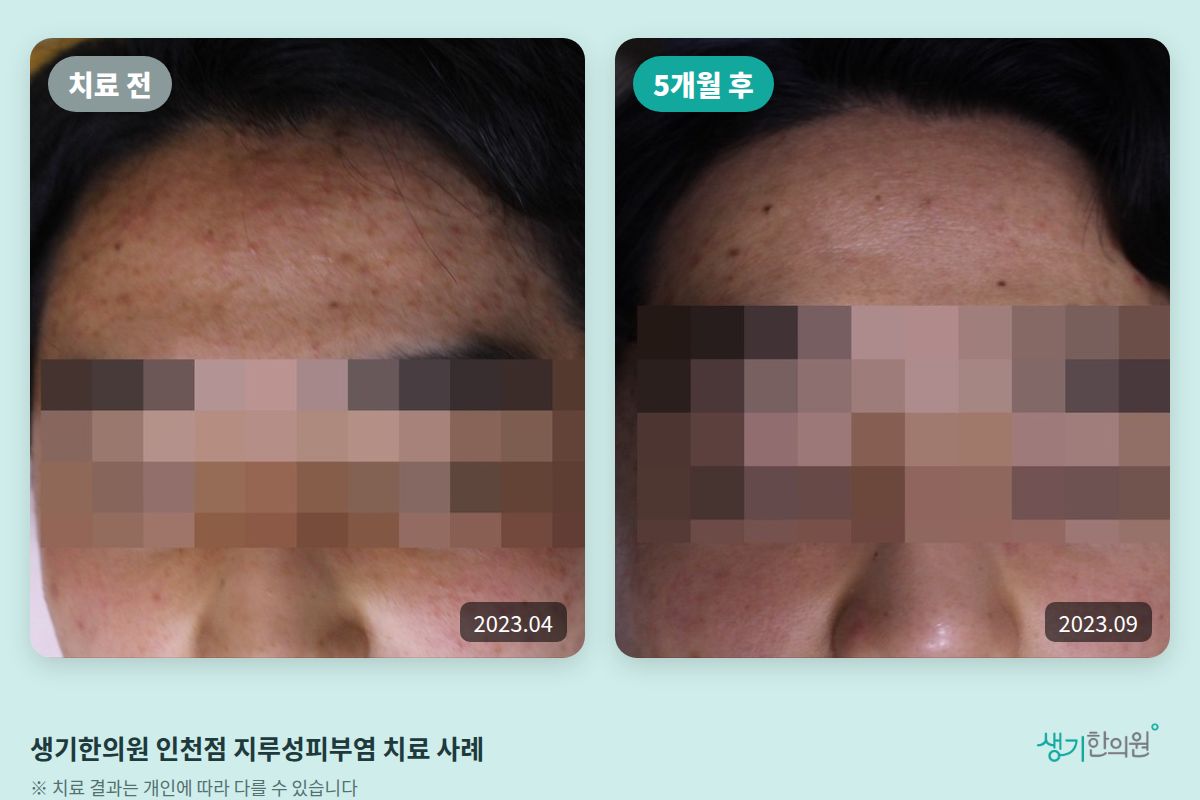 생기한의원 인천점 지루성피부염 치료 전(2023.04)과 5개월 후(2023.09) 비교 사진
