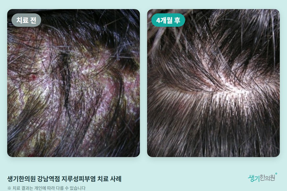 생기한의원 강남역점 지루성피부염 치료 전과 4개월 후 비교 사진