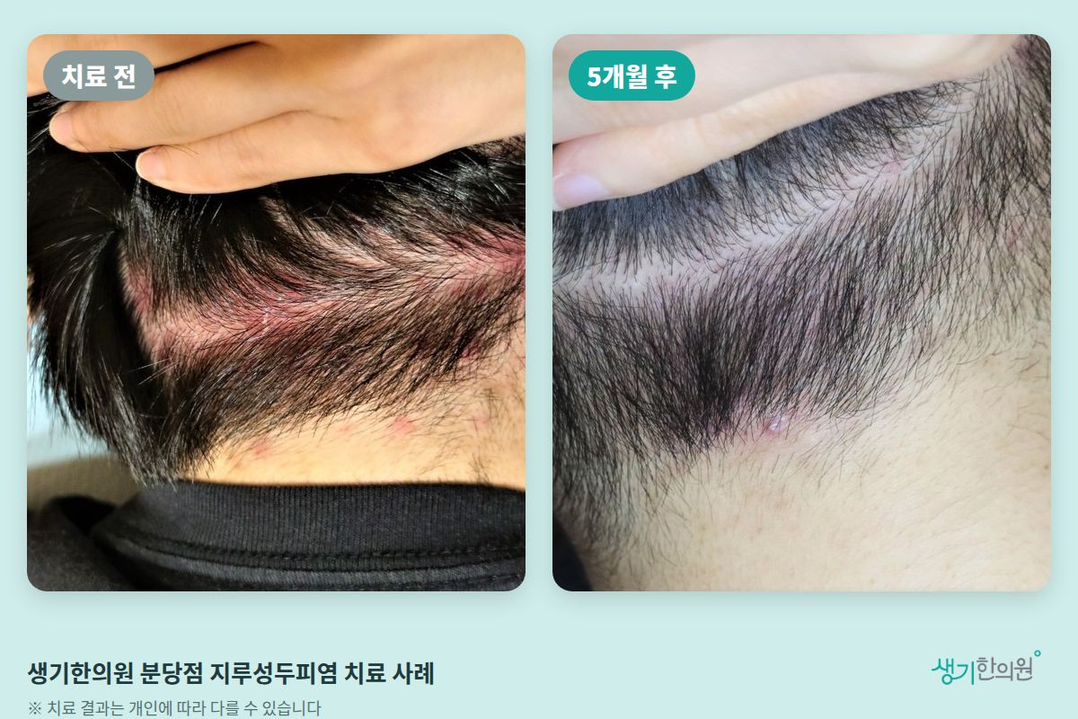 생기한의원 분당점 지루성두피염 치료 전과 5개월 후 비교 사진