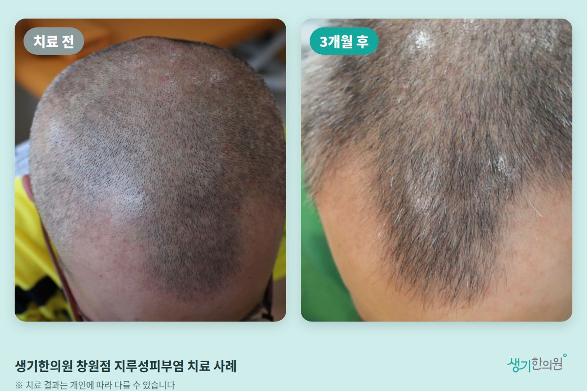 생기한의원 창원점 지루성피부염 치료 전과 3개월 후 비교 사진