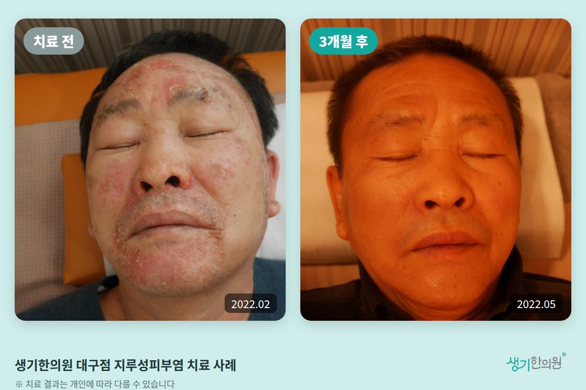 생기한의원 대구점 지루성피부염 치료 전(2022.02)과 3개월 후(2022.05) 비교 사진