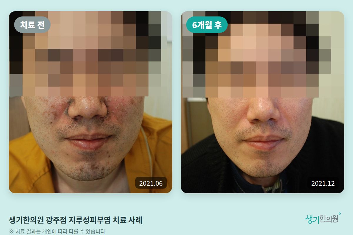 생기한의원 광주점 지루성피부염 치료 전(2021.06)과 6개월 후(2021.12) 비교 사진