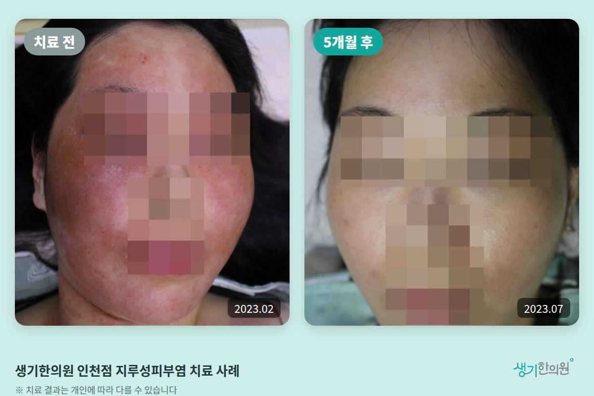 생기한의원 인천점 지루성피부염 치료 전(2023.02)과 5개월 후(2023.07) 비교 사진
