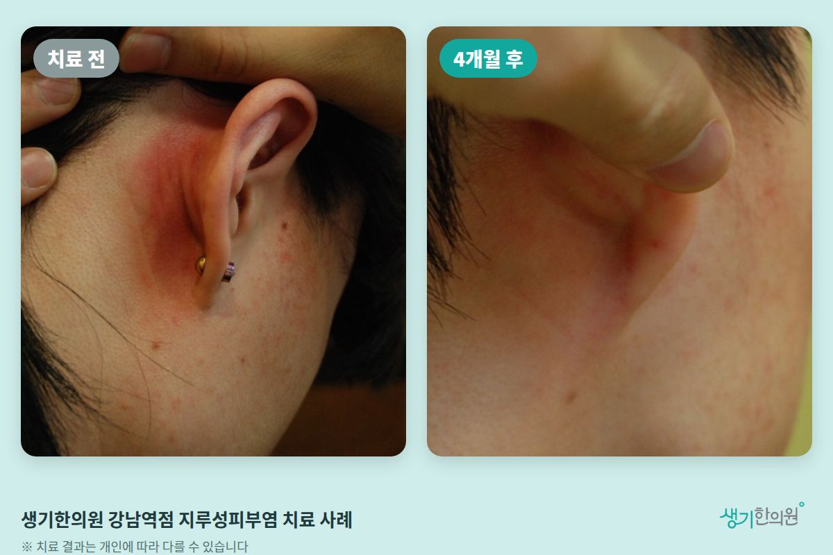 생기한의원 강남역점 지루성피부염 치료 전과 4개월 후 비교 사진