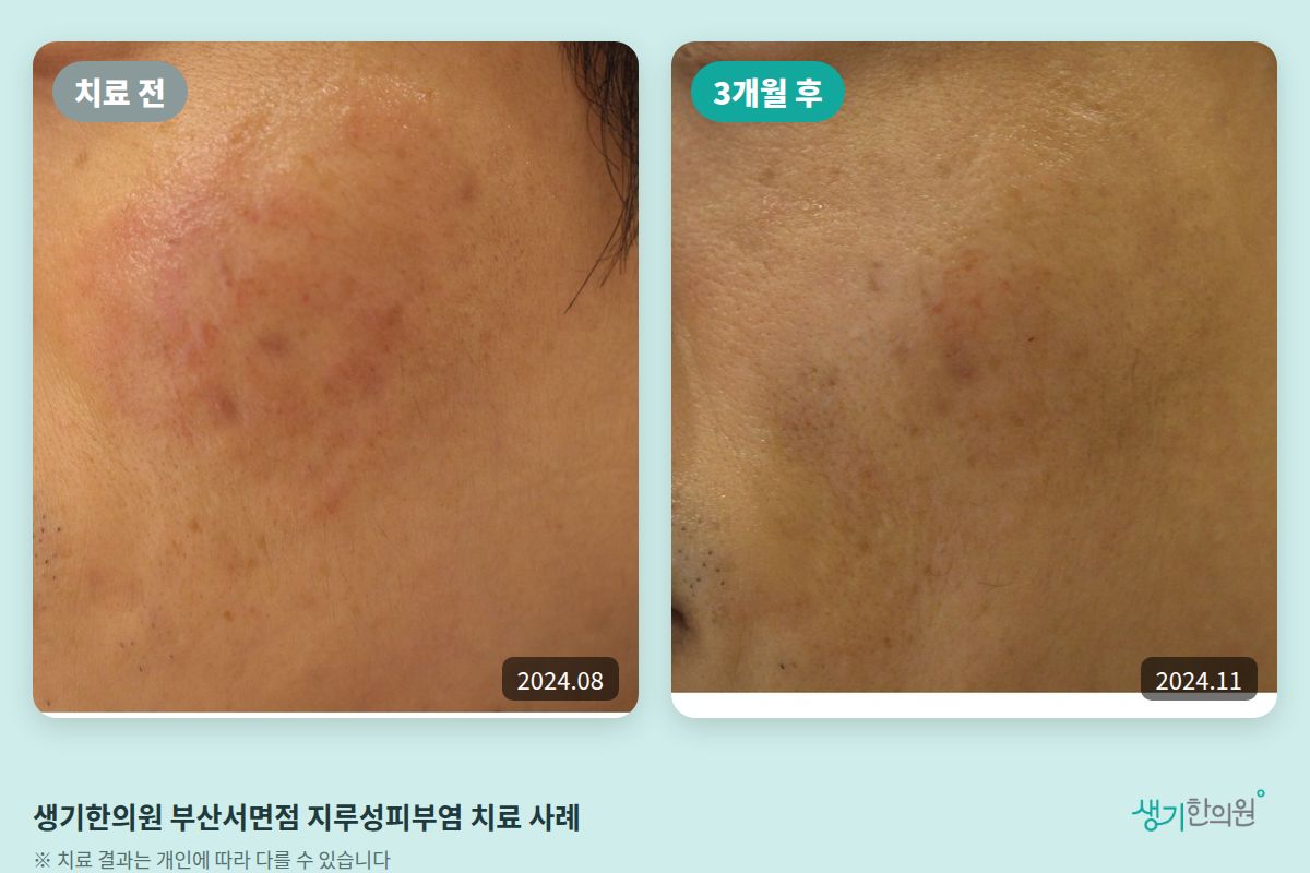 생기한의원 부산서면점 지루성피부염 치료 전(2024.08)과 3개월 후(2024.11) 비교 사진