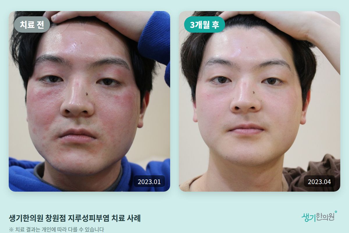 생기한의원 창원점 지루성피부염 치료 전(2023.01)과 3개월 후(2023.04) 비교 사진