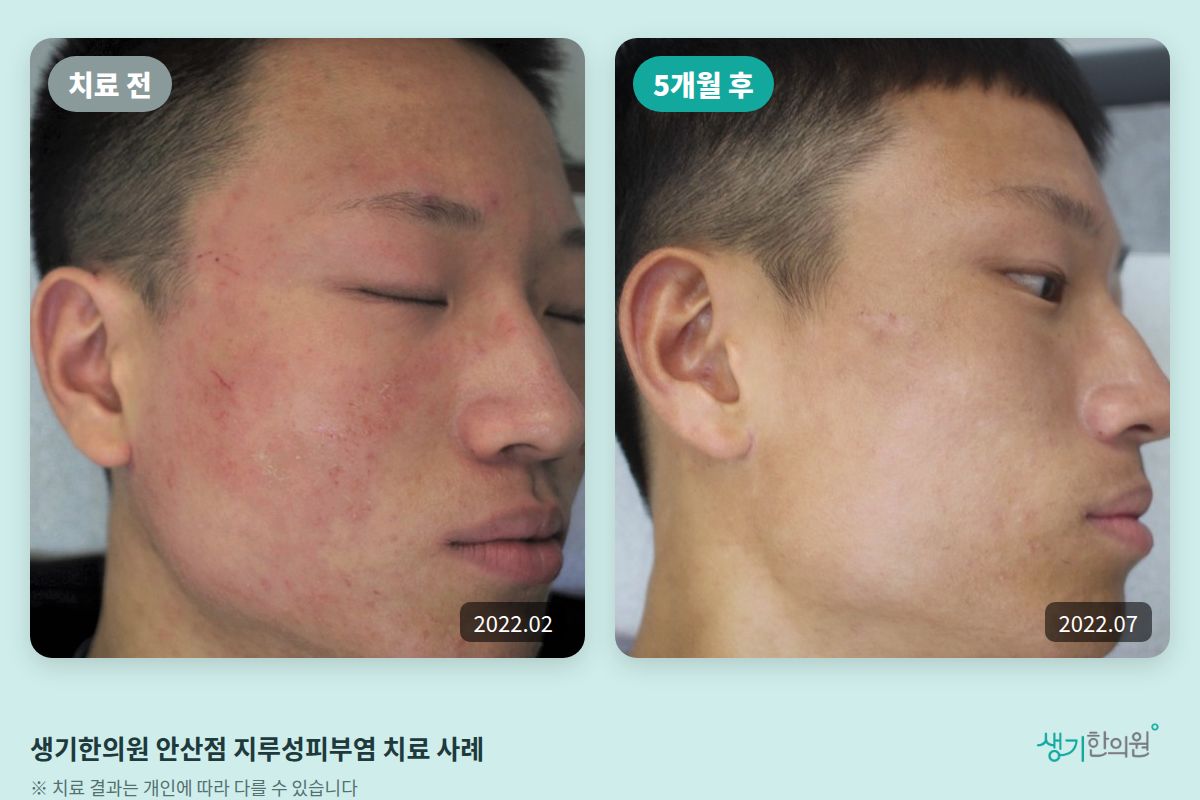 생기한의원 안산점 지루성피부염 치료 전(2022.02)과 5개월 후(2022.07) 비교 사진
