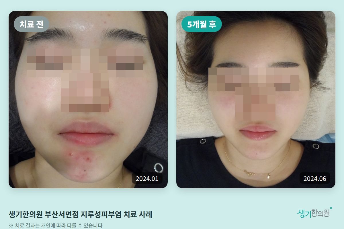 생기한의원 부산서면점 지루성피부염 치료 전(2024.01)과 5개월 후(2024.06) 비교 사진