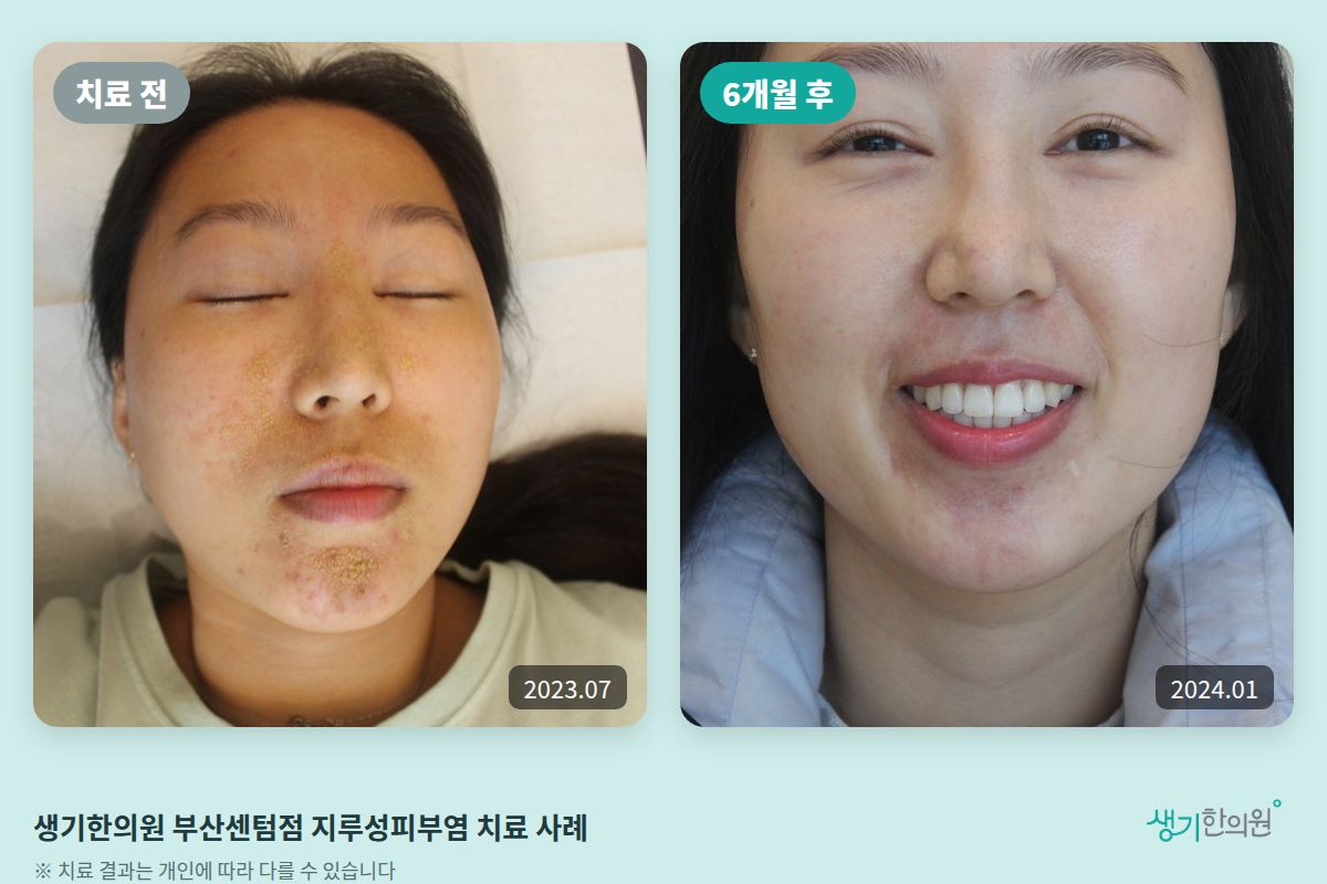 생기한의원 부산센텀점 지루성피부염 치료 전(2023.07)과 6개월 후(2024.01) 비교 사진