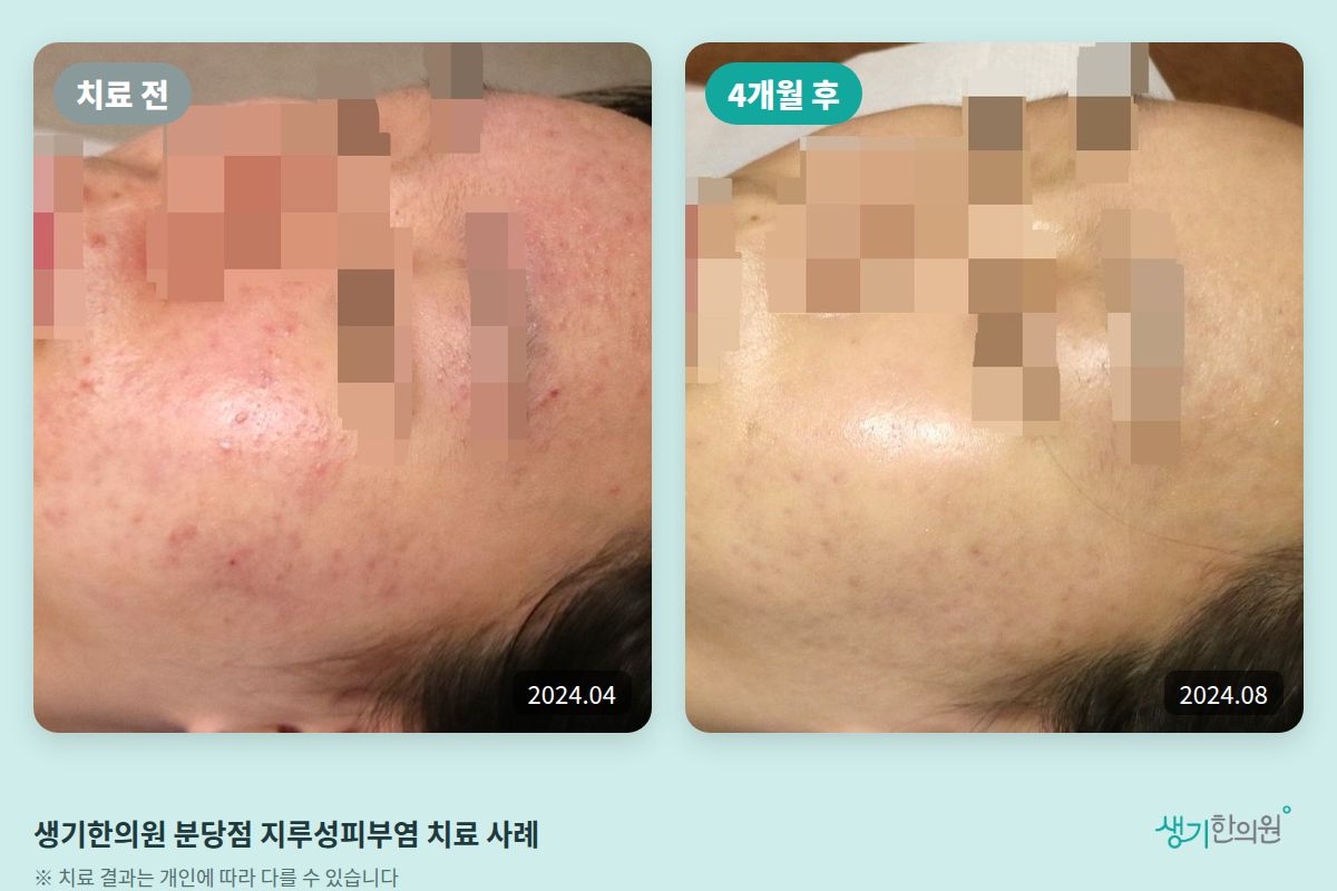 생기한의원 분당점 지루성피부염 치료 전(2024.04)과 4개월 후(2024.08) 얼굴 비교 사진