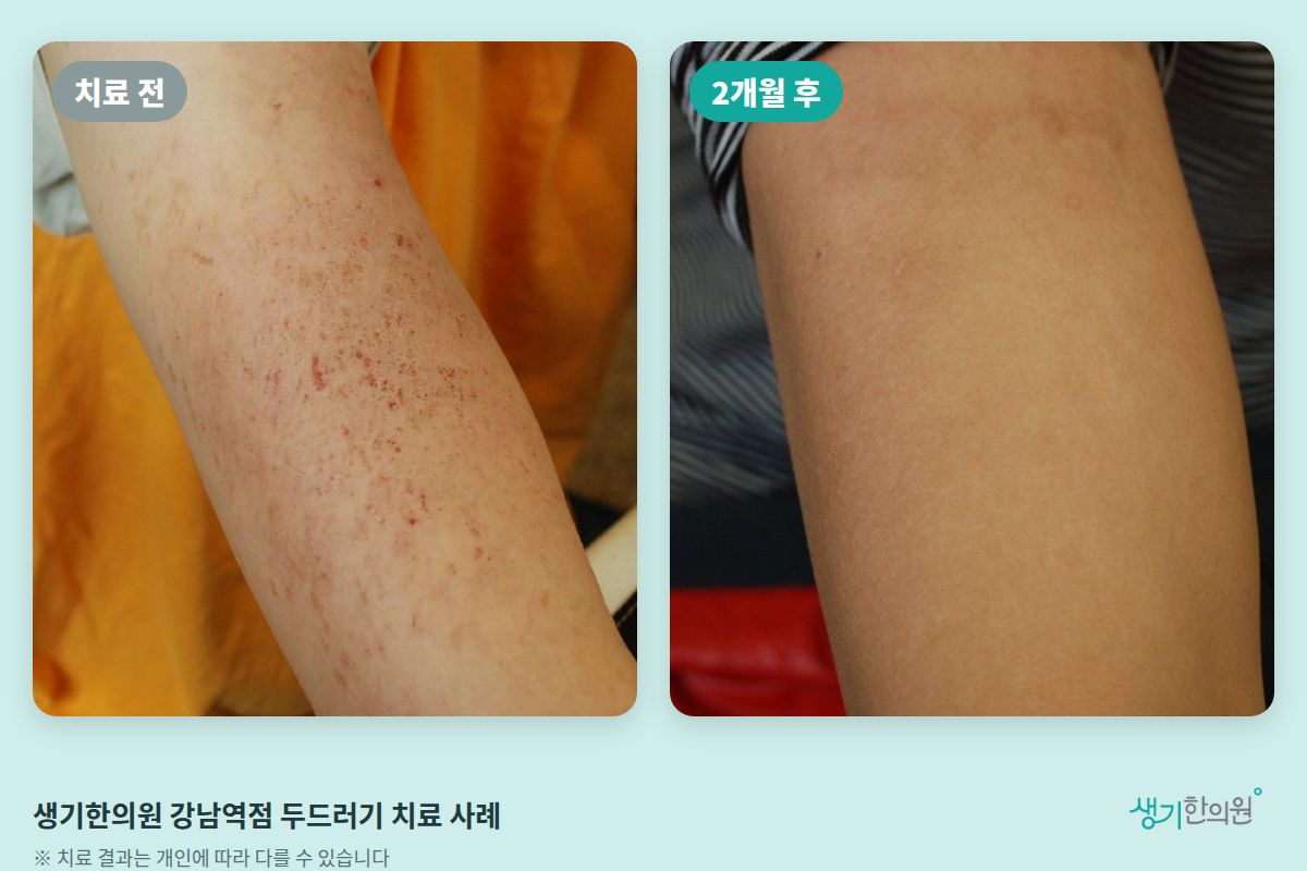 생기한의원 강남역점 두드러기 치료 전과 2개월 후 비교 사진