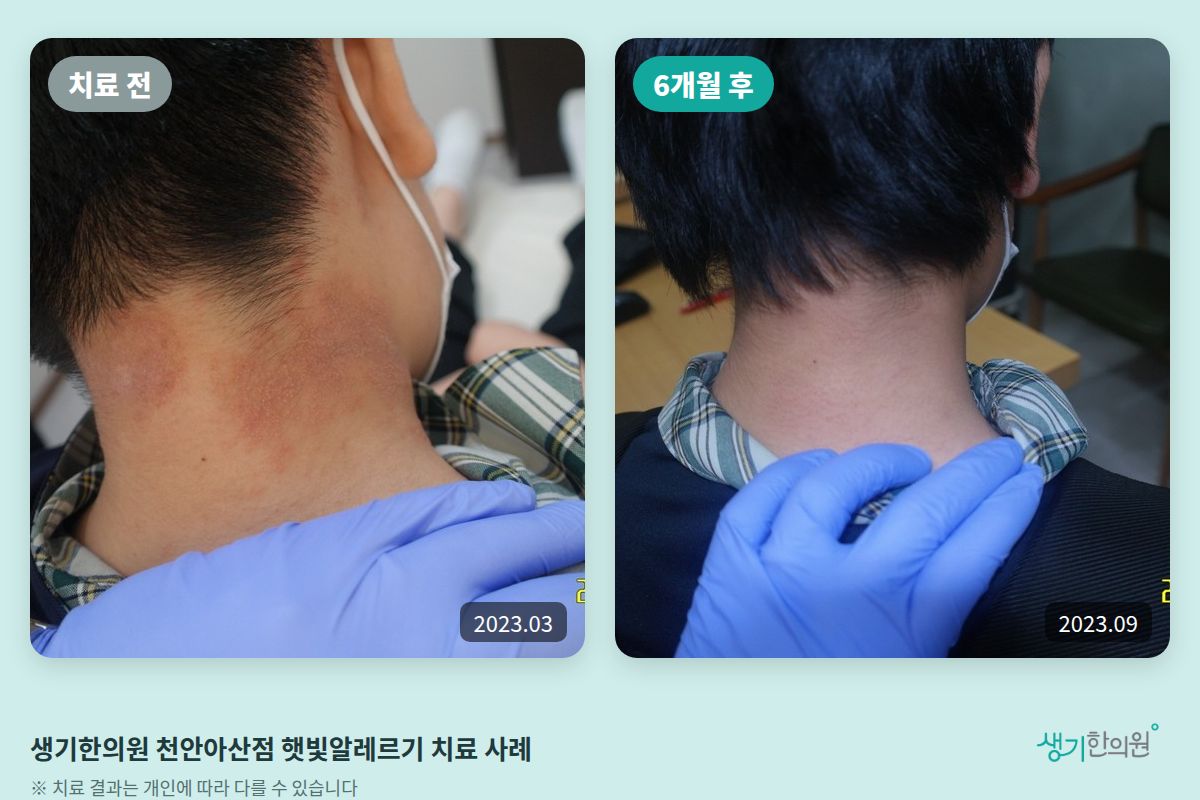생기한의원 천안아산점 햇빛알레르기 치료 전(2023.03)과 6개월 후(2023.09) 비교 사진