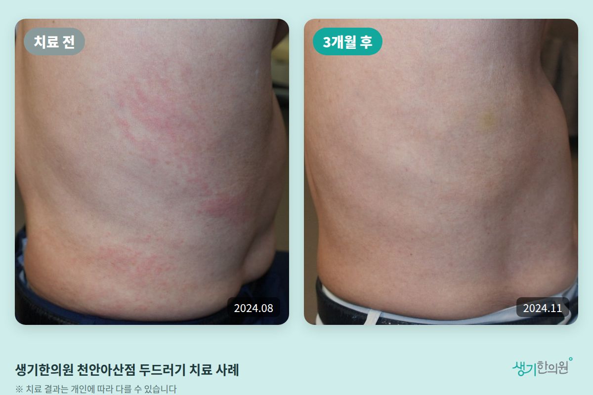 생기한의원 천안아산점 두드러기 치료 전(2024.08)과 3개월 후(2024.11) 비교 사진
