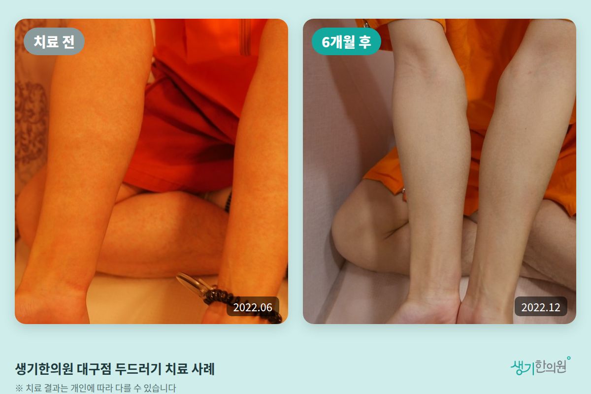 생기한의원 대구점 두드러기 치료 전(2022.06)과 6개월 후(2022.12) 비교 사진
