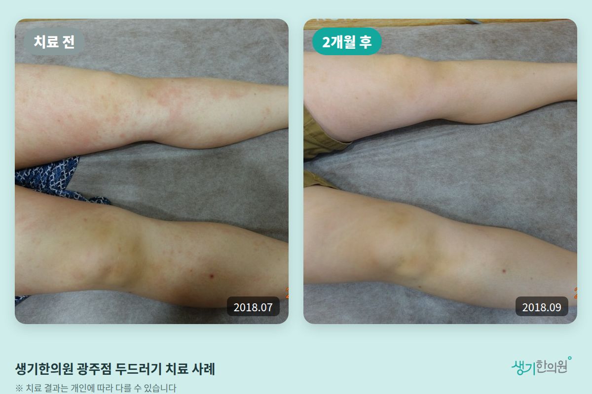 생기한의원 광주점 두드러기 치료 전(2018.07)과 2개월 후(2018.09) 비교 사진