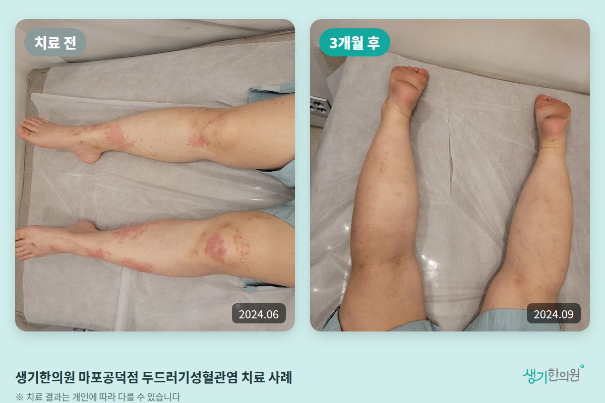 생기한의원 마포공덕점 두드러기성혈관염 치료 전(2024.06)과 3개월 후(2024.09) 비교 사진
