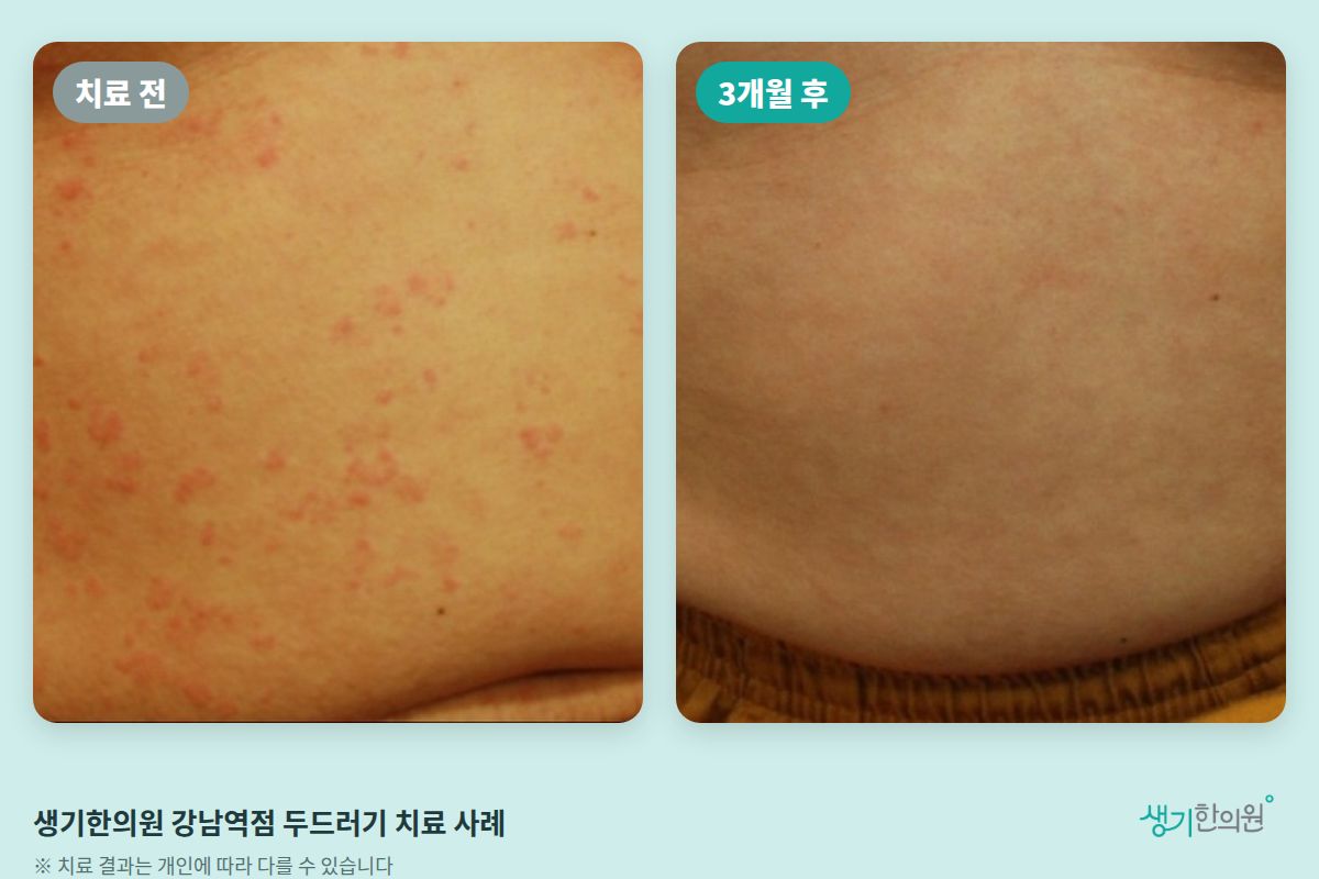 생기한의원 강남역점 두드러기 치료 전과 3개월 후 비교 사진
