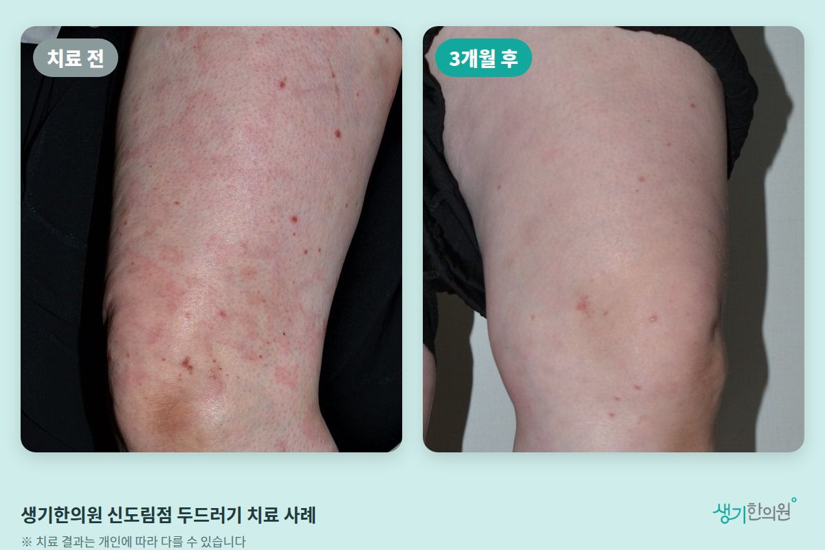 생기한의원 신도림점 두드러기 치료 전과 3개월 후 비교 사진