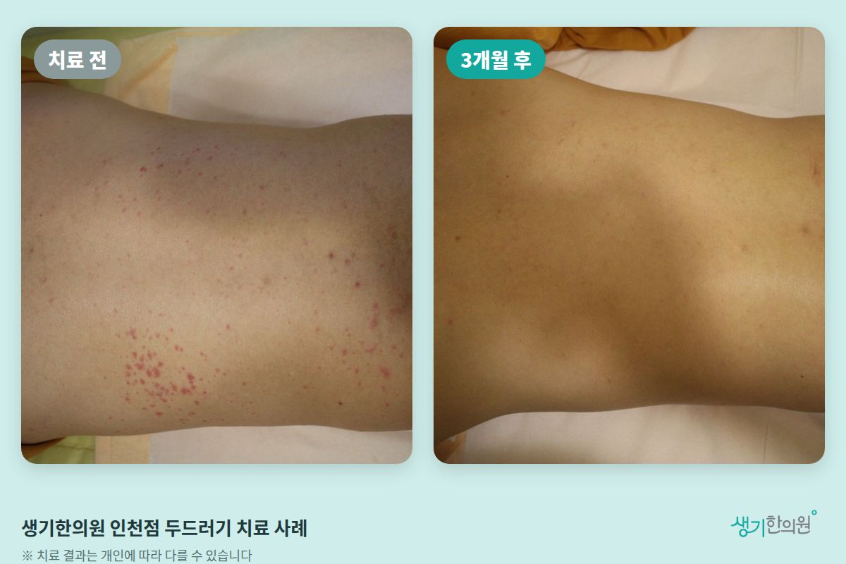 생기한의원 인천점 두드러기 치료 전과 3개월 후 비교 사진