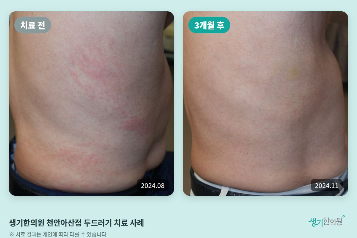 생기한의원 천안아산점 두드러기 치료 전(2024.08)과 3개월 후(2024.11) 옆구리 비교 사진