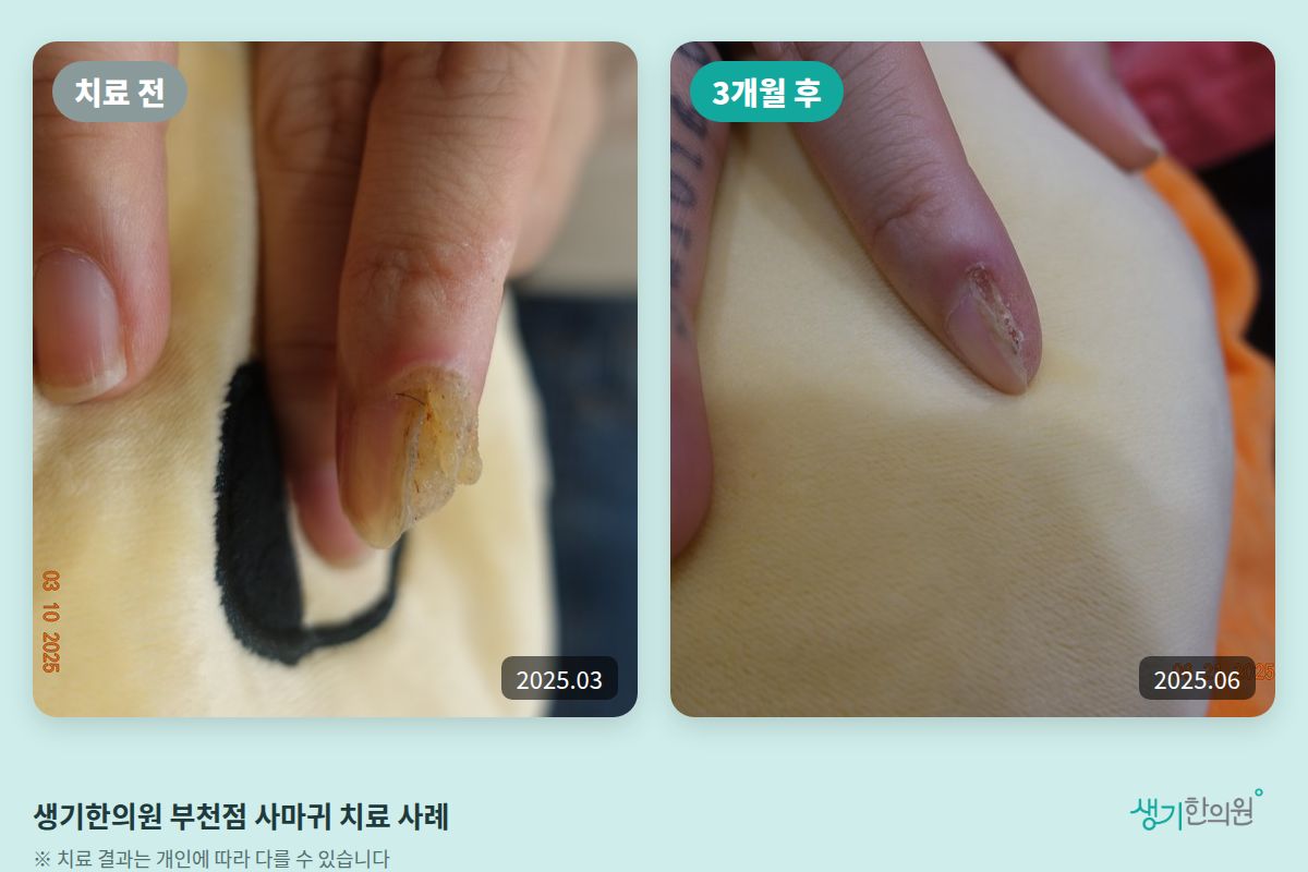 생기한의원 부천점 사마귀 치료 전(2025.03)과 3개월 후(2025.06) 비교 사진