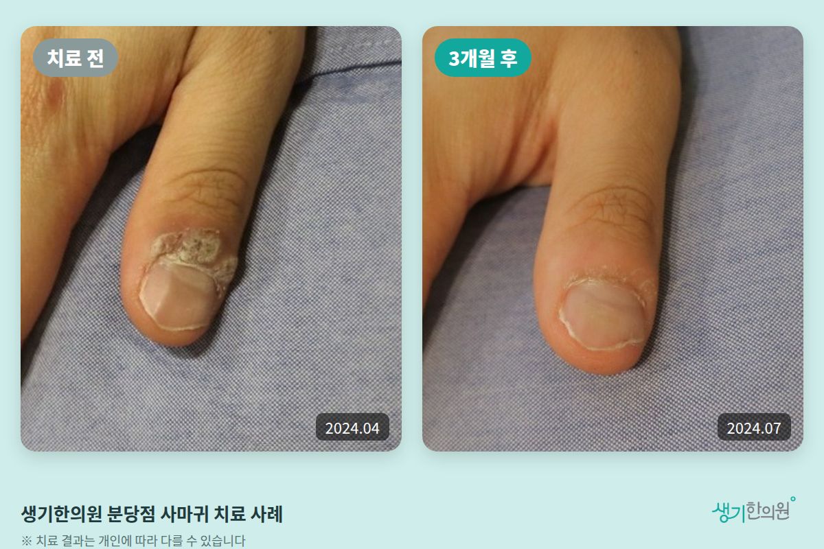 생기한의원 분당점 사마귀 치료 전(2024.04)과 3개월 후(2024.07) 비교 사진