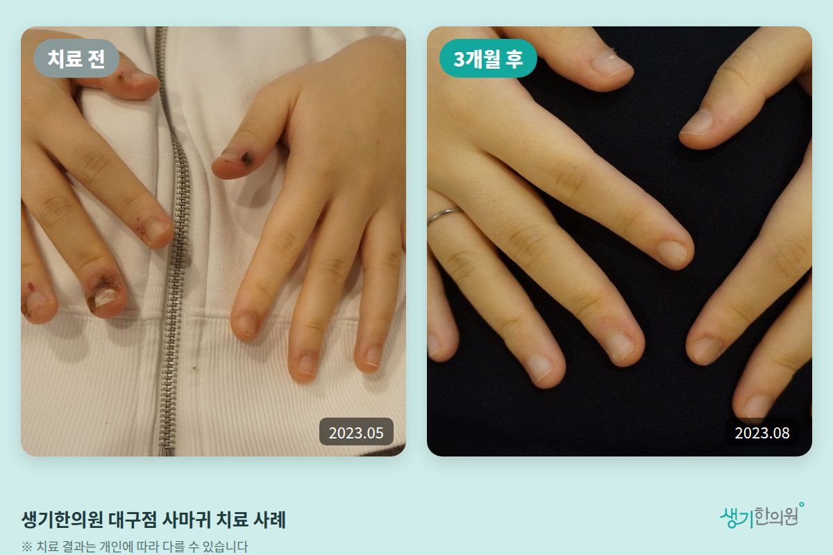 생기한의원 대구점 사마귀 치료 전(2023.05)과 3개월 후(2023.08) 비교 사진