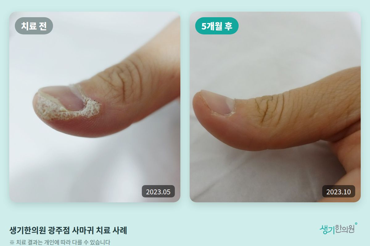 생기한의원 광주점 사마귀 치료 전(2023.05)과 5개월 후(2023.10) 비교 사진