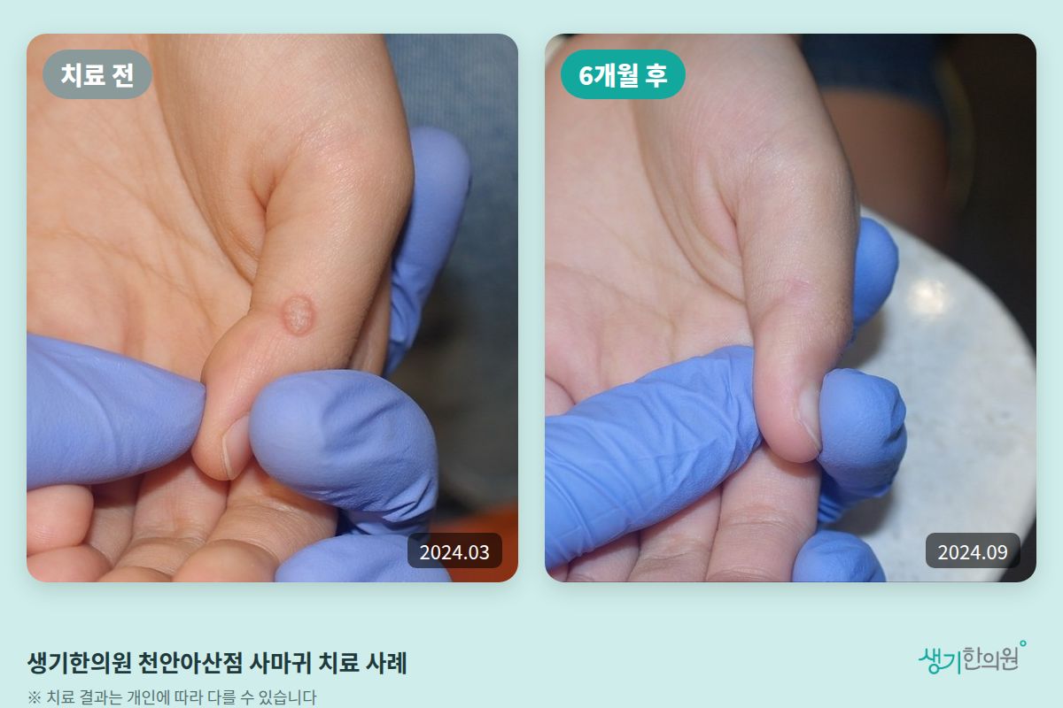 생기한의원 천안아산점 사마귀 치료 전(2024.03)과 6개월 후(2024.09) 비교 사진
