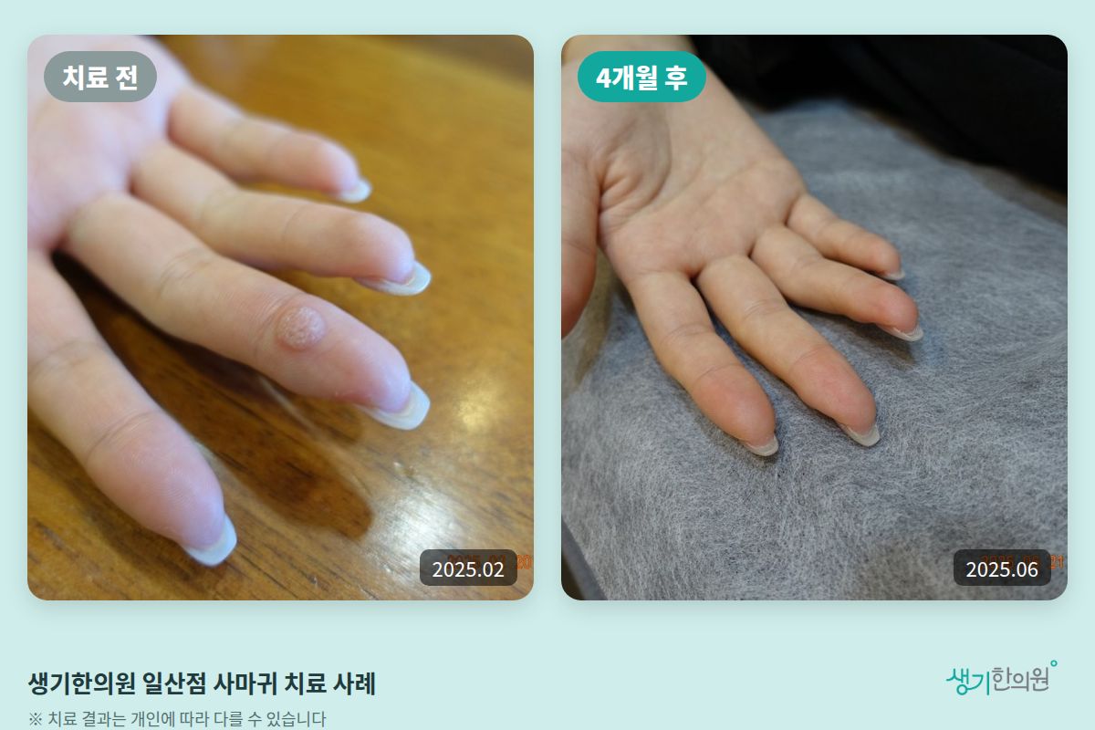생기한의원 일산점 사마귀 치료 전(2025.02)과 4개월 후(2025.06) 비교 사진
