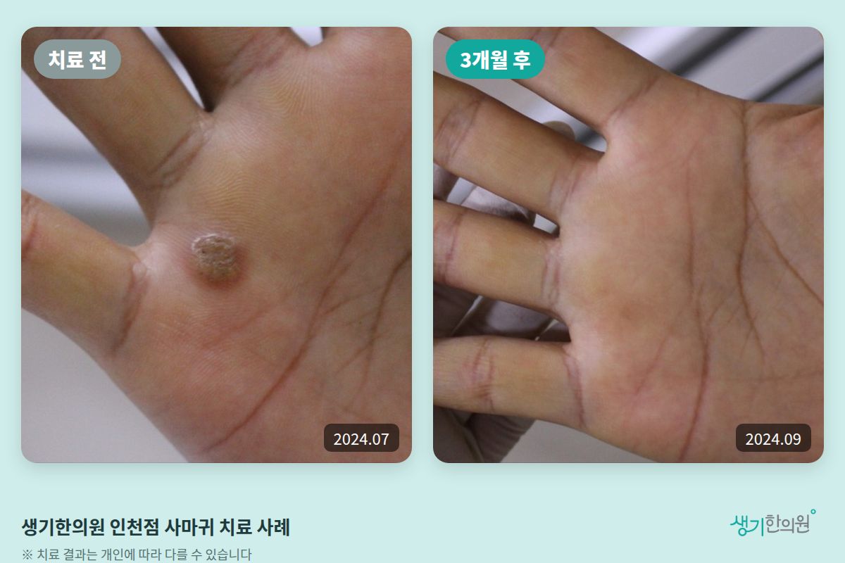생기한의원 인천점 사마귀 치료 전(2024.07)과 3개월 후(2024.09) 비교 사진