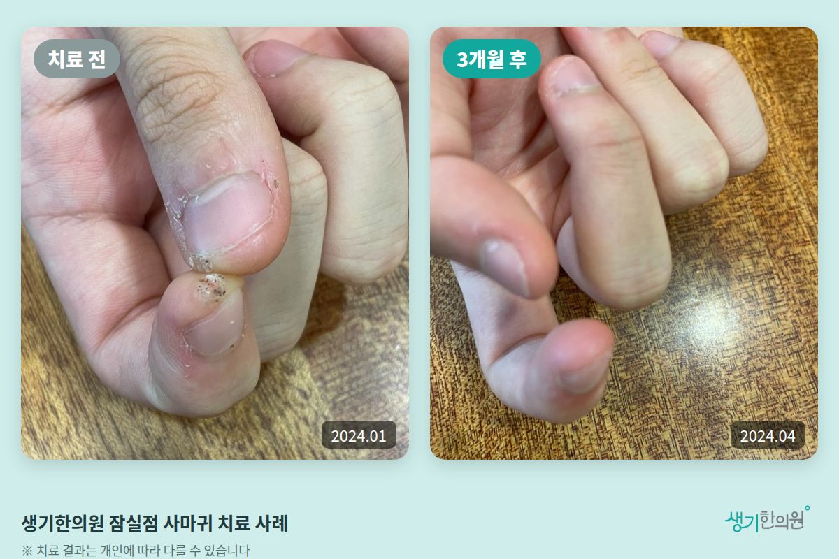 생기한의원 잠실점 사마귀 치료 전(2024.01)과 3개월 후(2024.04) 비교 사진