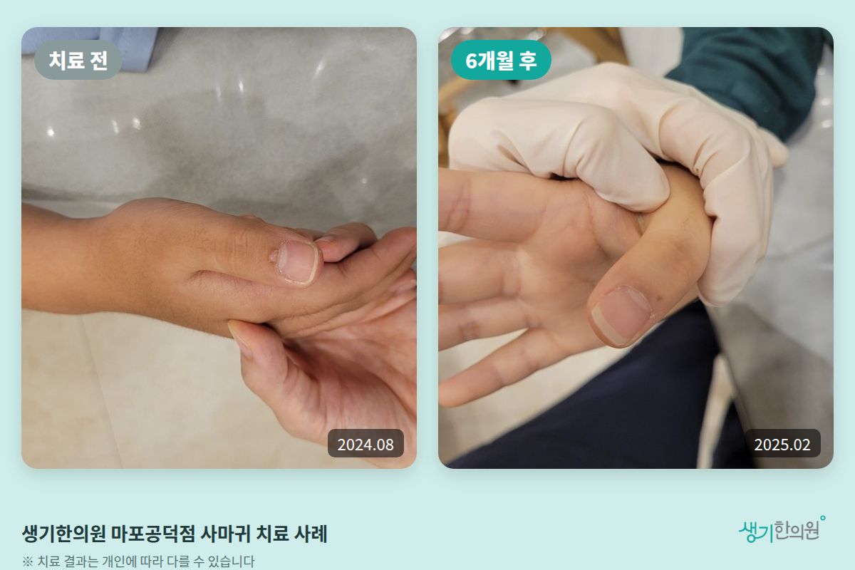 생기한의원 마포공덕점 사마귀 치료 전(2024.08)과 6개월 후(2025.02) 비교 사진