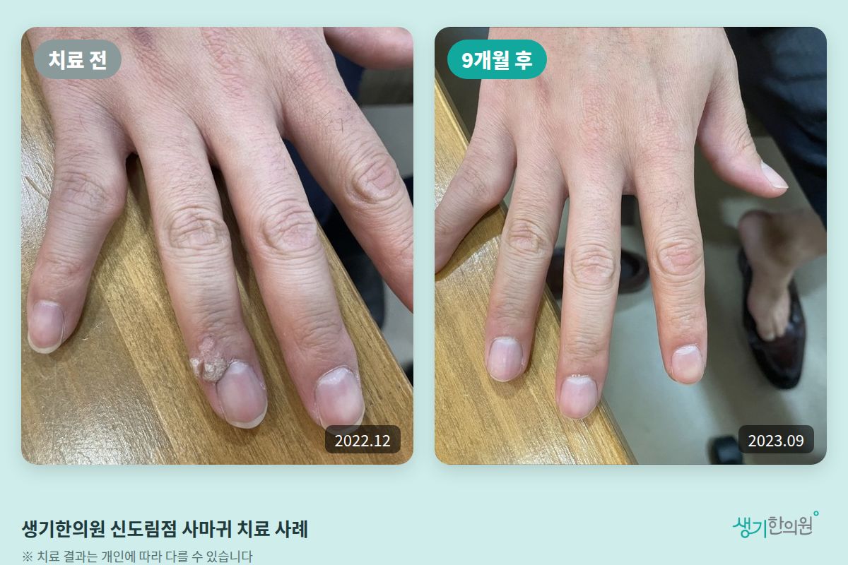생기한의원 신도림점 사마귀 치료 전(2022.12)과 9개월 후(2023.09) 비교 사진