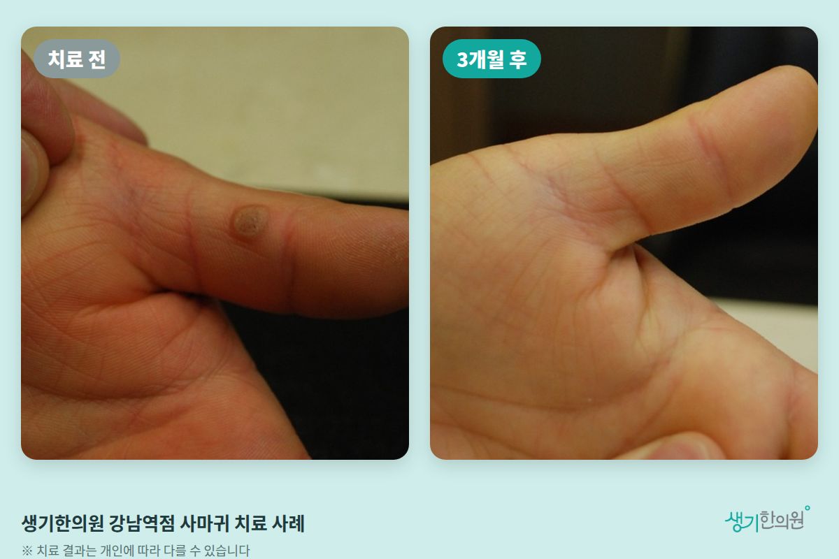 생기한의원 강남역점 사마귀 치료 전과 3개월 후 비교 사진