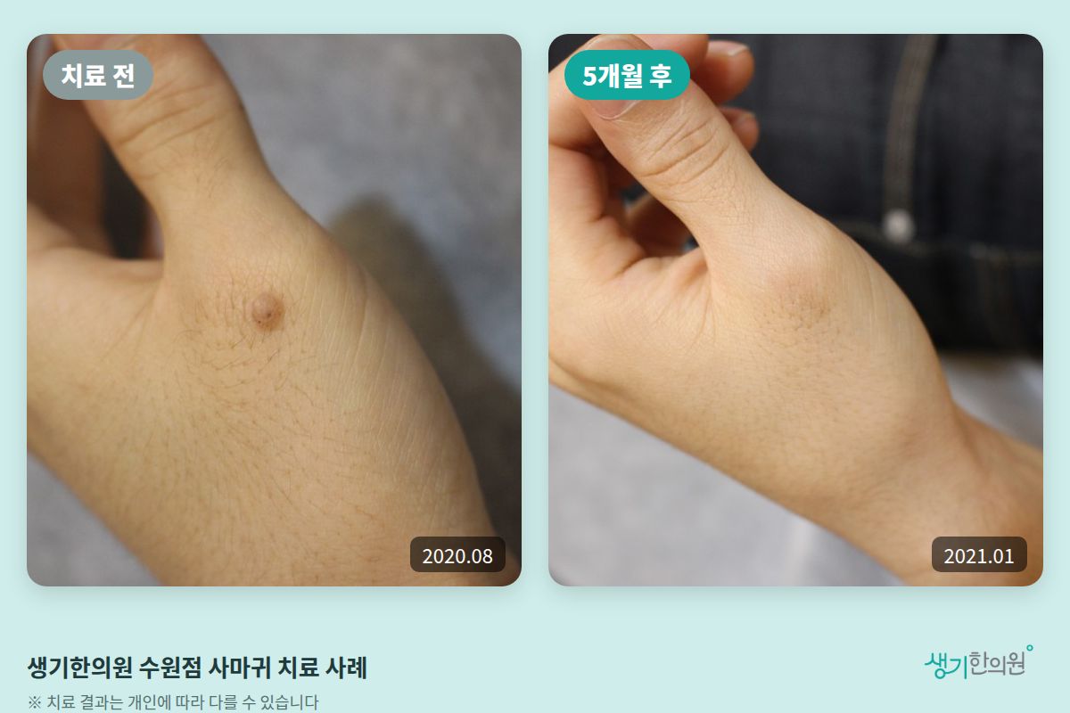 생기한의원 수원점 사마귀 치료 전(2020.08)과 5개월 후(2021.01) 비교 사진