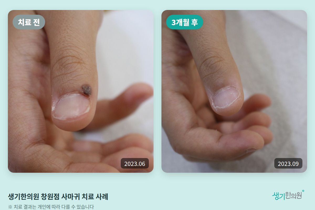 생기한의원 창원점 사마귀 치료 전(2023.06)과 3개월 후(2023.09) 비교 사진