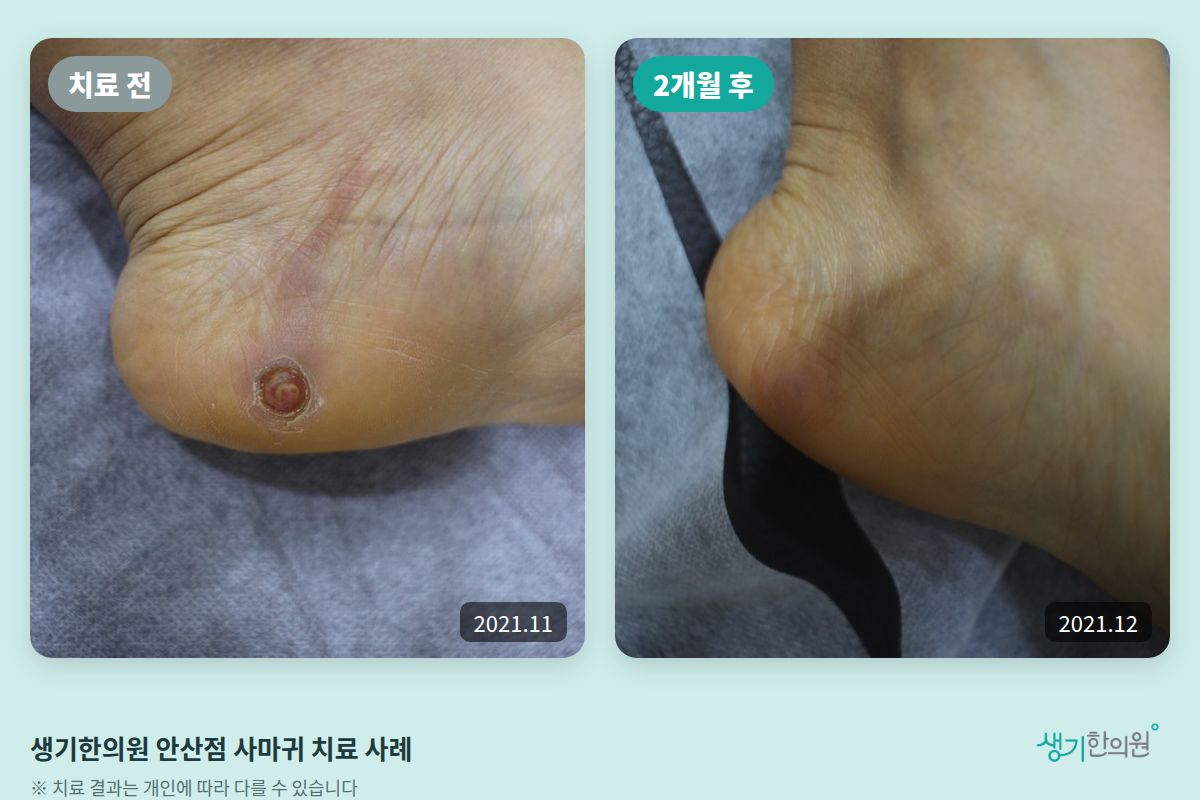 생기한의원 안산점 사마귀 치료 전(2021.11)과 2개월 후(2021.12) 비교 사진