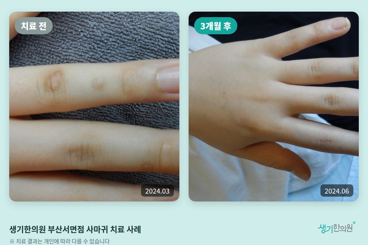 생기한의원 부산서면점 사마귀 치료 전(2024.03)과 3개월 후(2024.06) 비교 사진