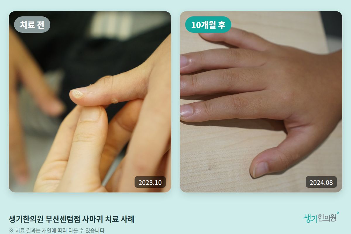 생기한의원 부산센텀점 사마귀 치료 전(2023.10)과 10개월 후(2024.08) 비교 사진