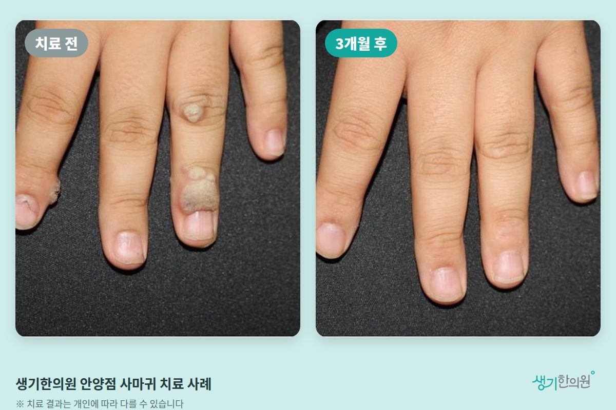 생기한의원 안양점 사마귀 치료 전과 3개월 후 비교 사진