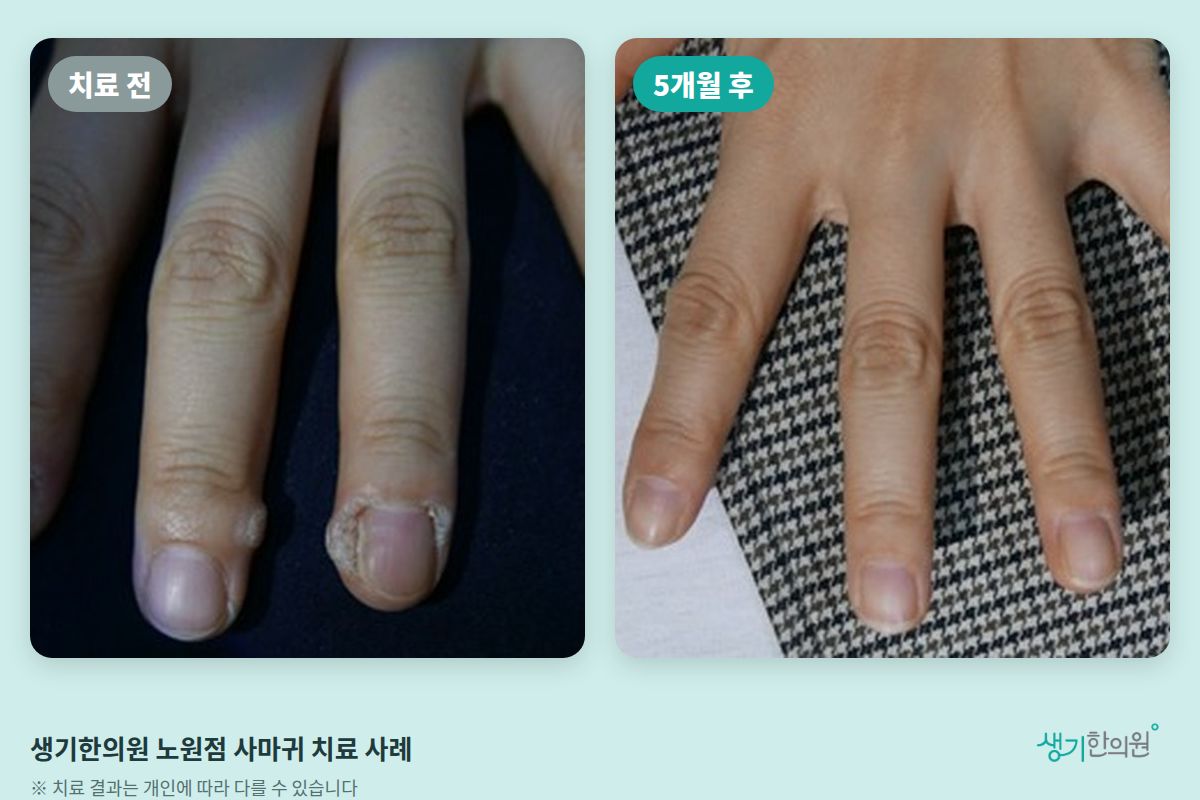 생기한의원 노원점 사마귀 치료 전과 5개월 후 손가락 비교 사진